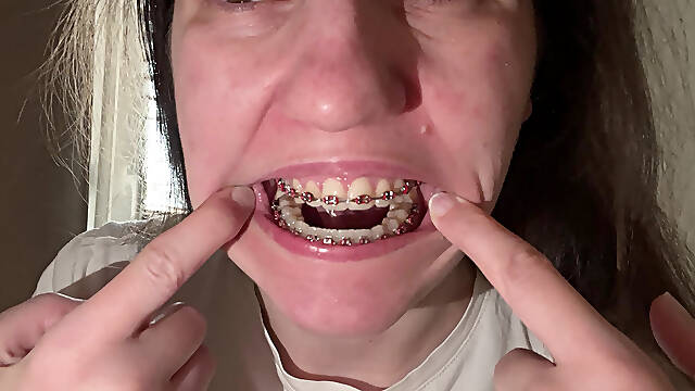 Licking Your Braces with Your Tongue
